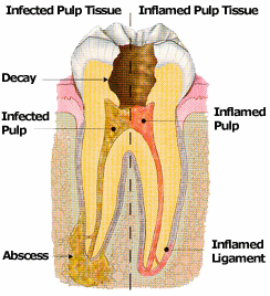 Conventional Root Canal Treatment by Dr. Steven Cohen Endodontist in Mississauga