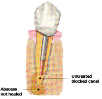 Endodontic Retreatment by Dr. Steven Cohen Endodontist in Mississauga GTA