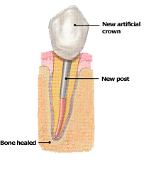 Endodontic Retreatment by Dr. Steven Cohen Endodontist in Mississauga GTA