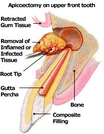 Surgical Root canal treatment in Mississauga by Endodontist, Dr. Steven Cohen.