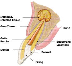 Surgical Root canal treatment by Dr. Steven Cohen Endodontist in Mississauga GTA